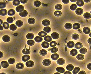 Blood under a microscope showing advanced spirochete forms Image by Holmes Health