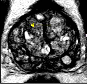 Anatomic MRI image of the prostate with arrow indicating abnormality