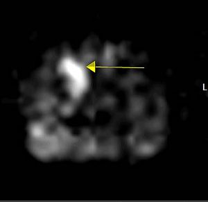 Functional MRI image demonstrating abnormality (arrow)