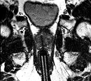 MRI-guided biopsy image of abnormality confirming cancer