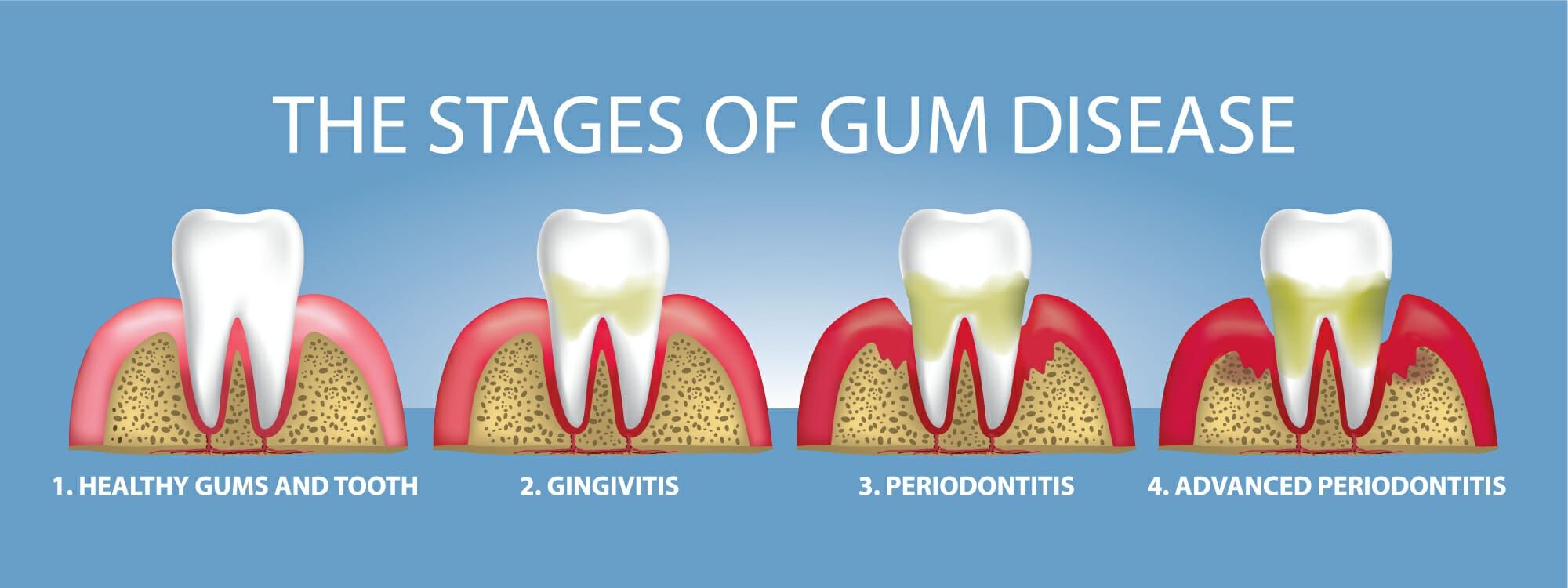 The stages of gun disease. 1. Healthy gums and tooth. 2. Gingivitis. 3. Periodontitis. 4. Advanced Periodontitis.