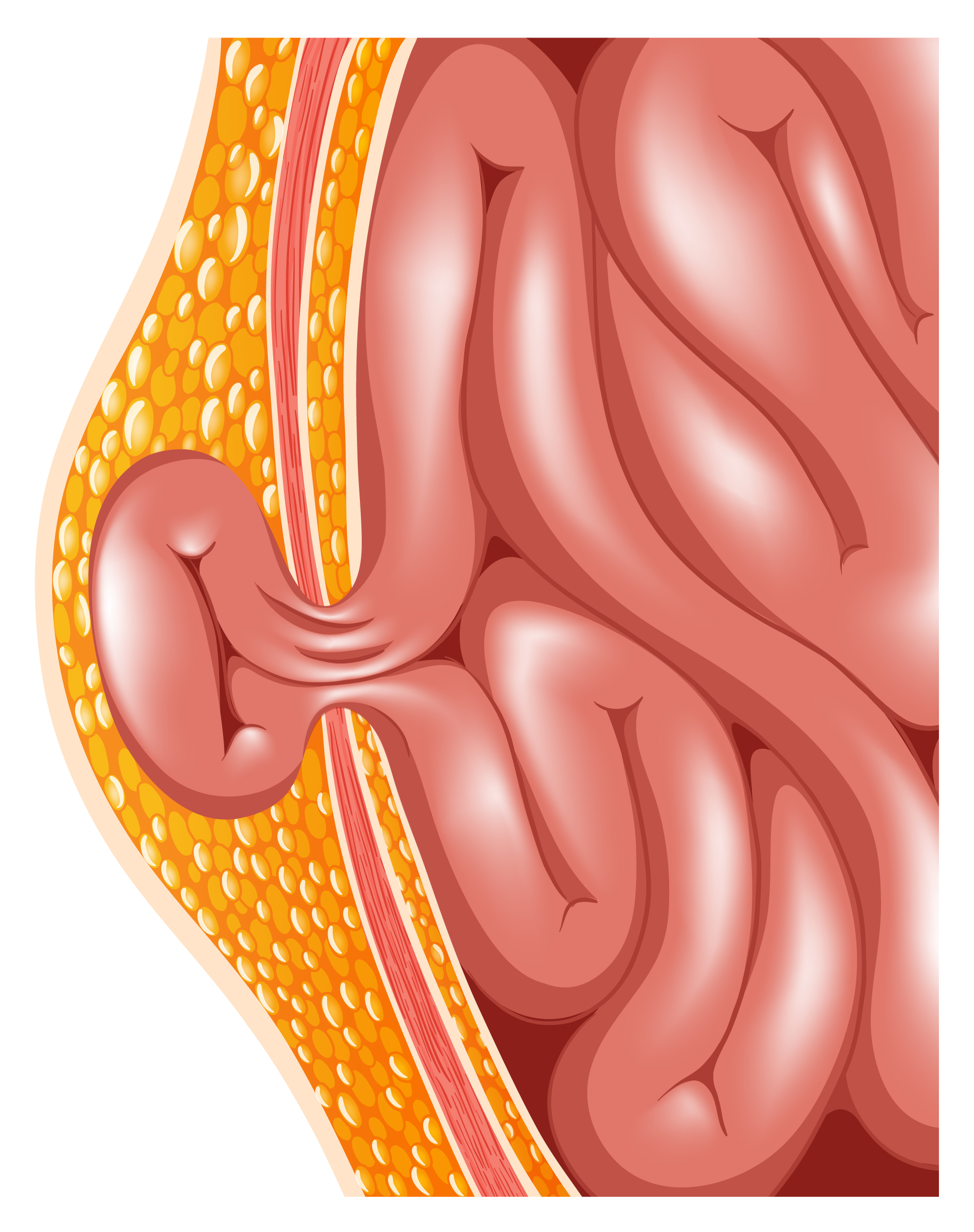 Advances In Groin Hernia Surgery Desert Health