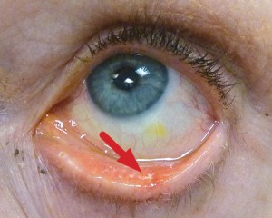 The affected inner surface of the eyelid is more irritated and inflamed than surrounding areas.
