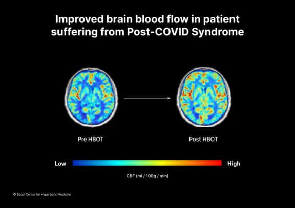 Hyperbaric Treatment Shows Promise for Long COVID - Desert Health®