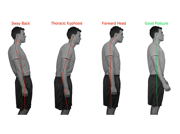 Frontotemporal dementia deals stance posture