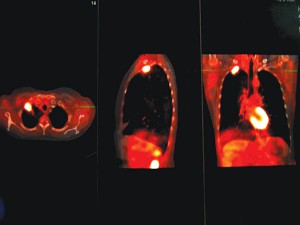 PET/CT demonstrating a lung cancer in the right lung apex and normal heart uptake