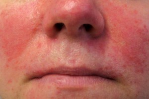 Signs of rosacea may include redness and/or small visible veins