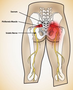 Ways To Relieve Sciatica Pain  Desert Institute For Spine Care