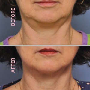 before-after-chin