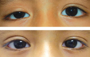 before-after-eyes-1