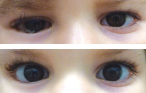 before-after-eyes-2