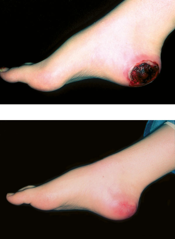 Before and after photos of diabetic foot wound healing from Hyperbaric Oxygen Therapy