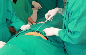 Traditional liposuction is still applicable in many cases.