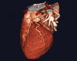 3D image of a heart taken with advanced CT technology