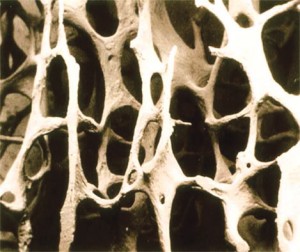 Osteoporosis