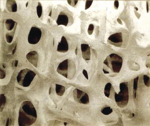 Osteoporosis Normal Bone