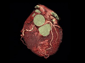 mn-Heart-CT-scan-DMI