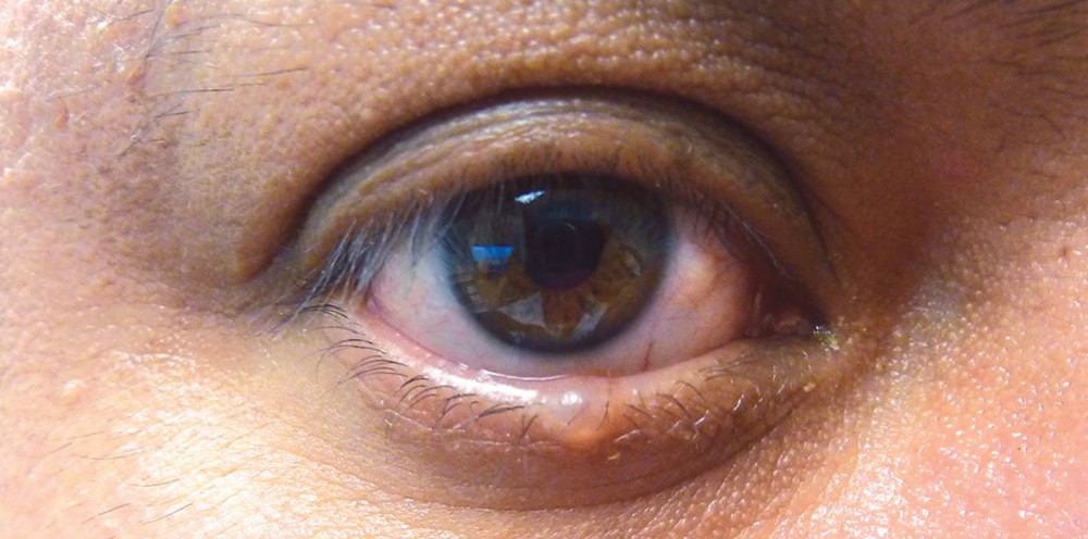 pimple-on-eyelid-under-inside-on-rim-small-white-lump-upper-eyelid