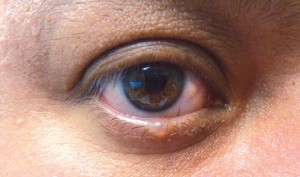 Eyelid cyst in the central portion of the right lower lid margin.  The lesion has a bubble-like appearance and is fluid filled.  It causes some distortion of the lash margin, but reassuring signs include the presence of eyelashes and lack of surface erosion.