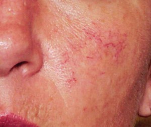 rosacea-before-and-after-1