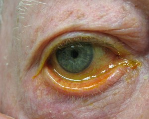 With senile ectropion, laxity of the eyelid may cause it to turn outward